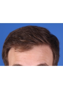 After Hair Transplant&nbsp;Front
